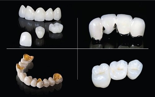 Làm răng sứ phải kiêng gì để duy trì kết quả? 2