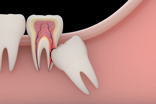 Răng khôn bị sâu chảy máu - Cách khắc phục an toàn 1