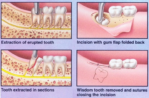 Răng khôn bị sâu chảy máu - Cách khắc phục an toàn 3