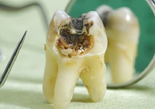 Răng khôn bị sâu có nên nhổ không? Nha khoa tư vấn 1