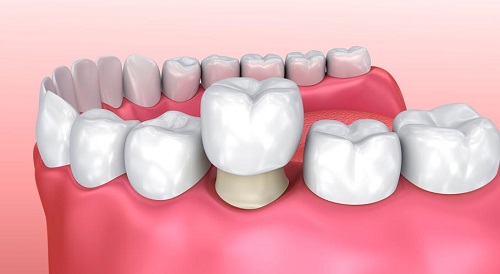 Răng sứ có bị sâu không? Cập nhật thông tin từ nha khoa 1