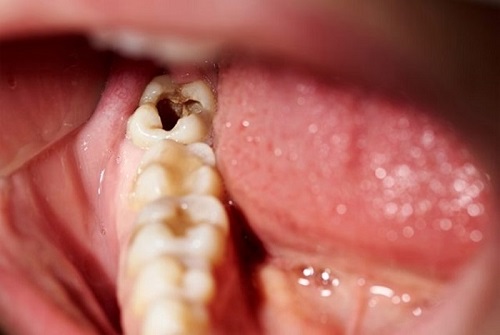 Răng khôn hàm trên bị vỡ - Cách xử lý an toàn 1