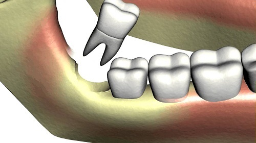 Răng khôn hàm trên bị vỡ - Cách xử lý an toàn 2