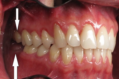 Răng khôn hàm trên có mấy chân? Kiến thức nha khoa 3