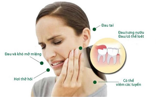 Răng khôn hàm trên mọc ngầm gây ra biến chứng gì?	2