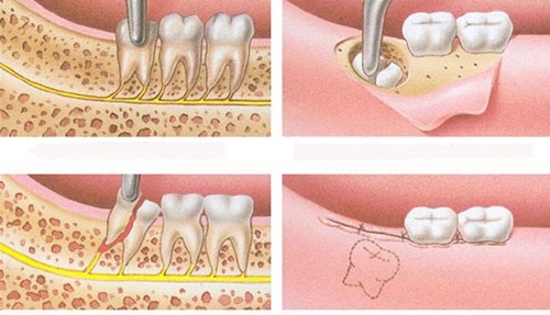 Răng khôn hàm trên mọc ngầm gây ra biến chứng gì?	3