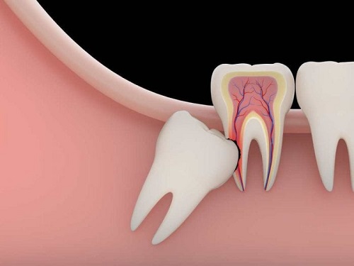 Răng khôn làm sâu răng số 7 - Biến chứng răng khôn 2