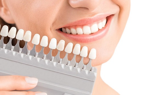 Làm răng sứ mất bao lâu? Tham khảo quy trình thực hiện 1