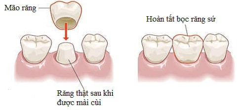 Làm răng sứ mất bao lâu? Tham khảo quy trình thực hiện 3