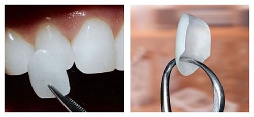 Làm răng sứ không mài răng - Quy trình thực hiện 2