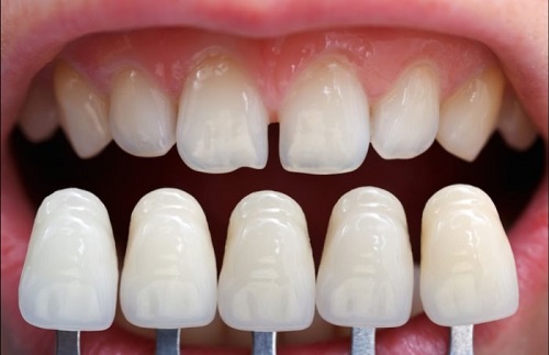 Làm răng sứ không mài răng - Quy trình thực hiện 3