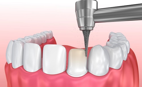 Làm răng sứ có đau không? Có ảnh hưởng đến răng miệng không? 2