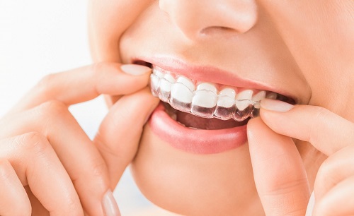Niềng răng áp dụng cho đối tượng nào? *