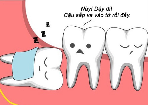 Răng khôn không đau có nên nhổ? Bác sĩ tư vấn 1