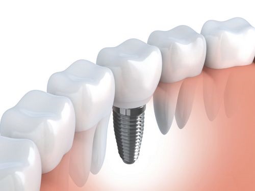 Trồng răng hàm implant giá bao nhiêu? Tìm hiểu giá niêm yết 2