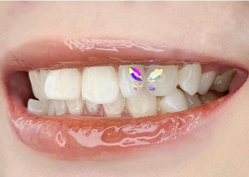 Răng sứ có đính đá được không? Tìm hiểu kỹ về răng sứ 3