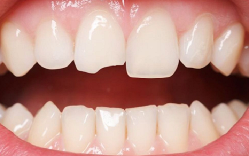 Răng sứ bị mòn - Nguyên nhân và cách khắc phục 2