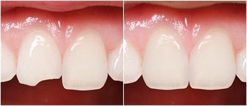 Răng sứ có trám được không? 2