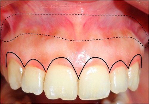 Lắp răng sứ bị sưng lợi - Cách khắc phục nhanh nhất 1