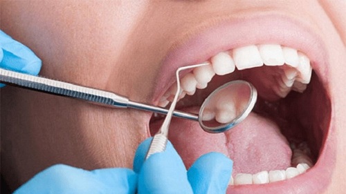 Lắp răng sứ bị sưng lợi - Cách khắc phục nhanh nhất 2