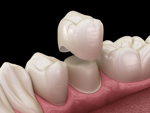 Lắp răng sứ bị sưng lợi - Cách khắc phục nhanh nhất 3