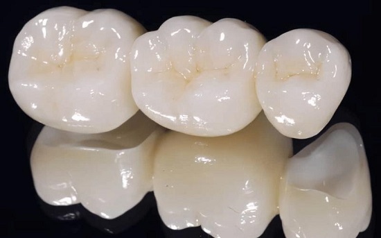 Có nên trồng răng sứ kim loại không? Bạn nên lưu ý gì? 2