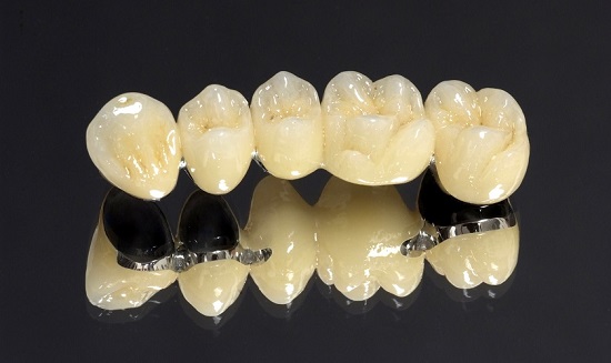 Có nên trồng răng sứ kim loại không? Bạn nên lưu ý gì? 3