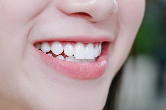 Răng sứ bị thưa khắc phục như thế nào? 1